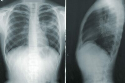 tuberculosis